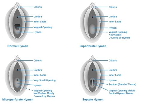 hymen pic|Hymen